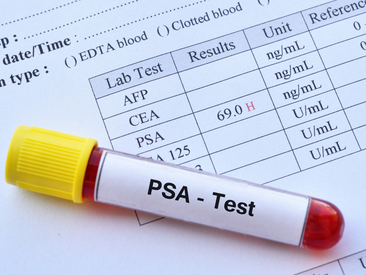 Update: Pressure for a National PSA Screening Programme