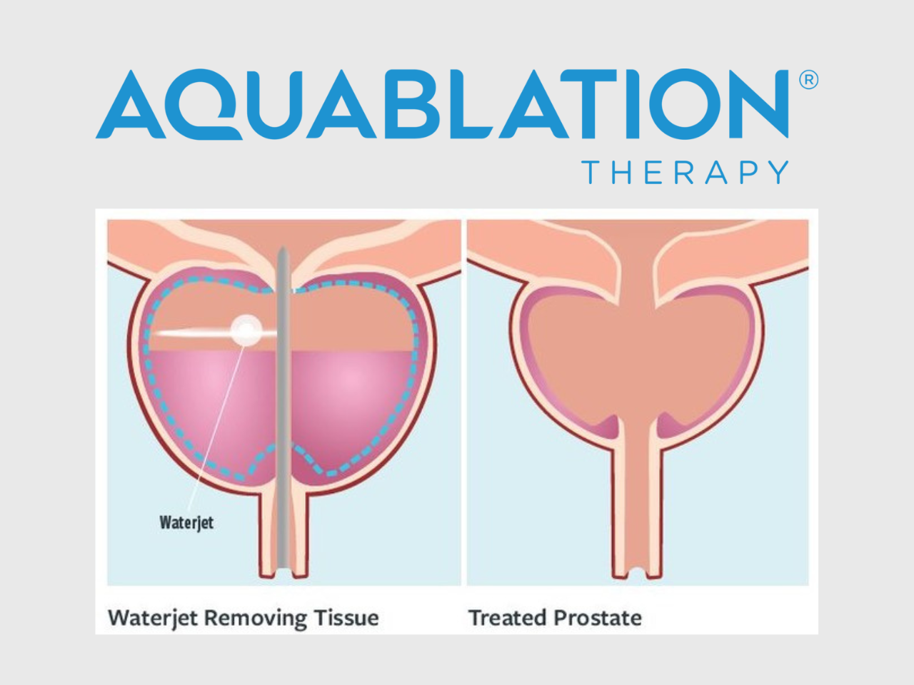 Aquablation® Therapy: A Modern Treatment Option for Men with Enlarged Prostate (BPH)